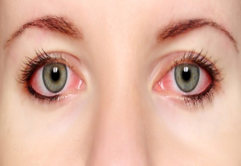 δώσε-τέλος-στα-κόκκινα-μάτια-οι-7-λόγοι-489518