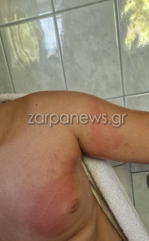 Συναγερμός στις παραλίες της Κρήτης: Θαλάσσιες ανεμώνες τσιμπάνε λουόμενους – Πολλαπλά περιστατικά μέσα σε λίγες μέρες