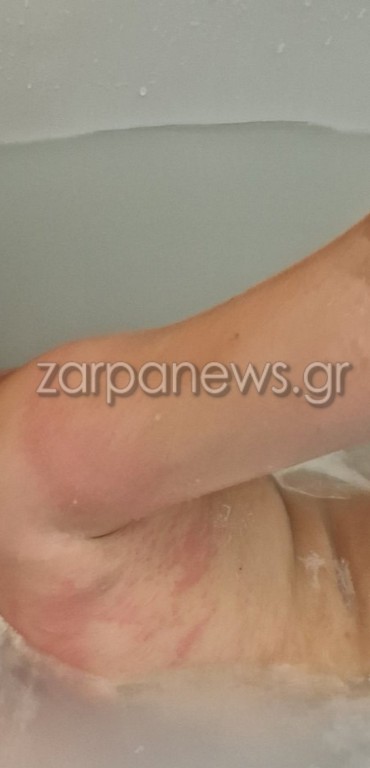 Συναγερμός στις παραλίες της Κρήτης: Θαλάσσιες ανεμώνες τσιμπάνε λουόμενους – Πολλαπλά περιστατικά μέσα σε λίγες μέρες